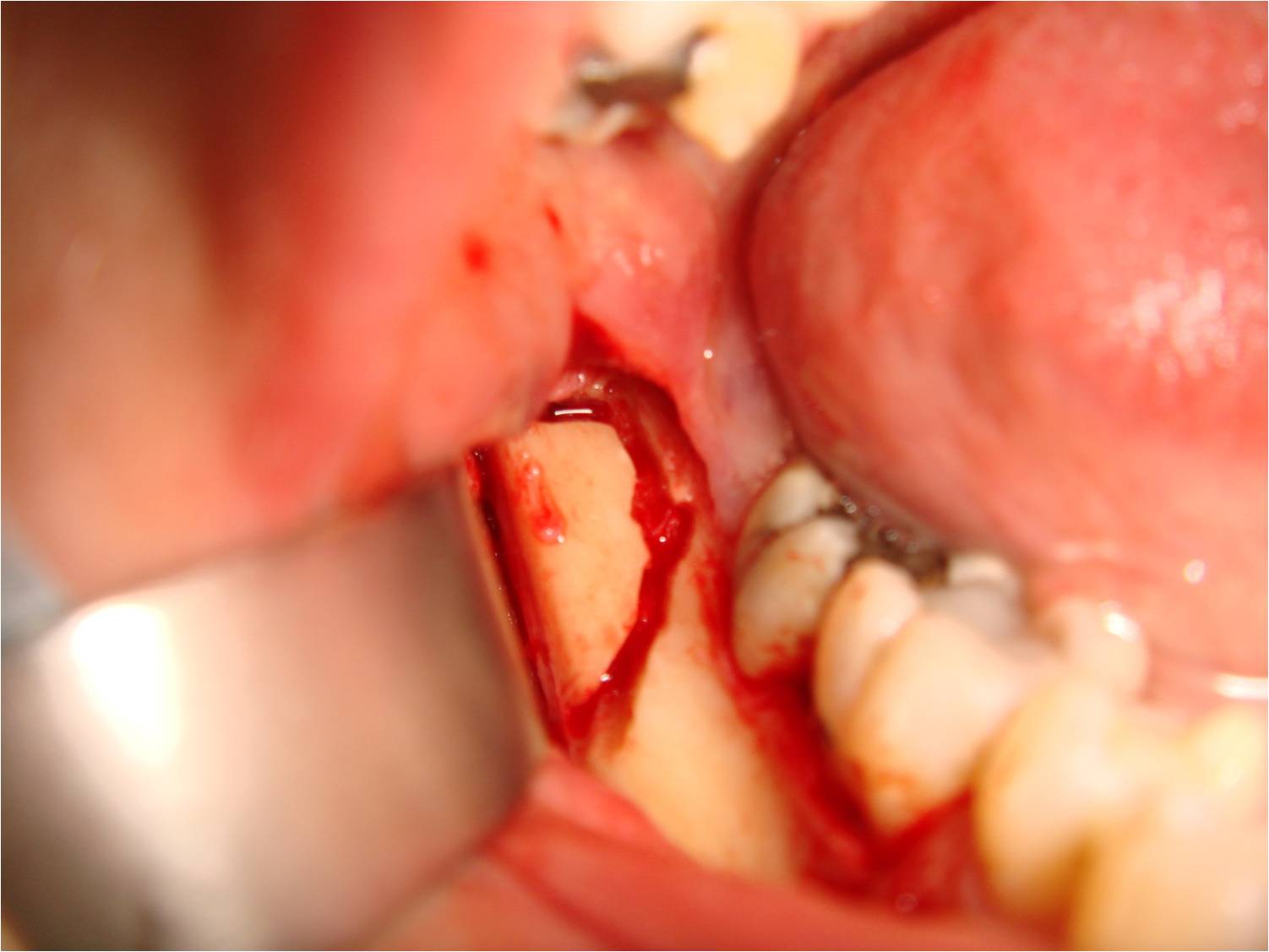 La greffe osseuse autogne d'apposition en onlay - Dentiste Meulan